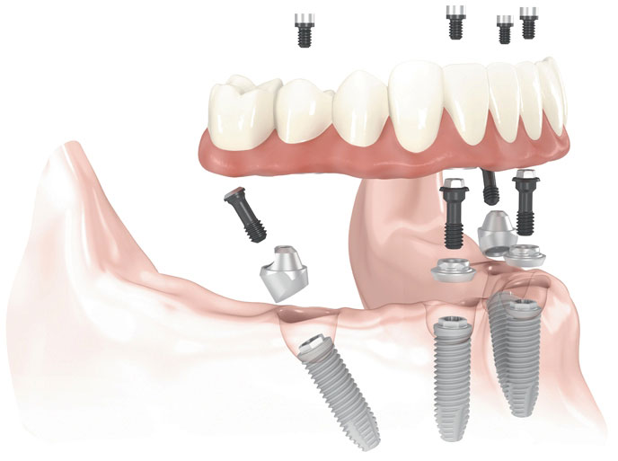 Dental Implants for Missing Tooth Replacement