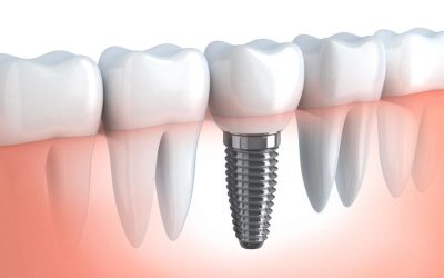 What Is Involved in Getting a Dental Implant?