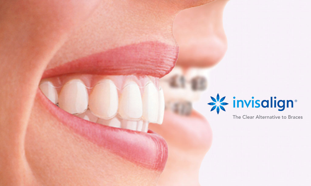 Invisalign AXIS Dental Brampton Canada